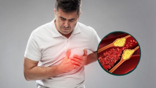 Lầm tưởng thường gặp về cholesterol