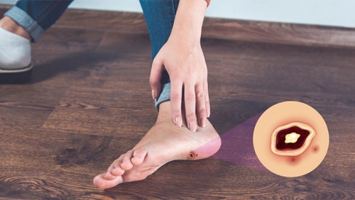 Bạn cần biết gì về biến chứng bàn chân do đái tháo đường?