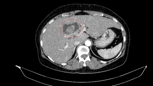 Phát hiện mắc đồng thời 2 bệnh ung thư nguy hiểm từ dấu hiệu vàng da