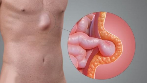 Làm thế nào để tự đánh giá nguy cơ mắc thoát vị?