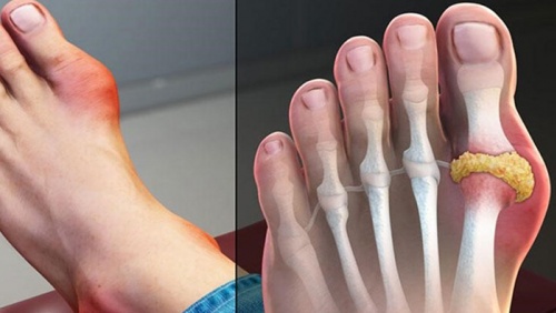 Bệnh gout cấp có chữa khỏi được không?