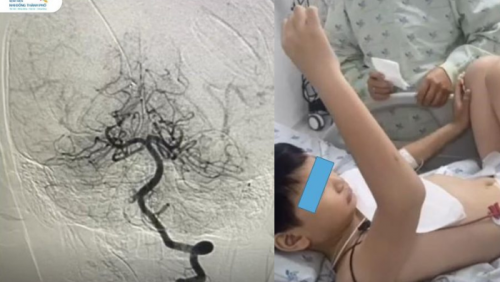 Bé trai 10 tuổi suýt liệt nửa người sau khi đi chơi cầu lông