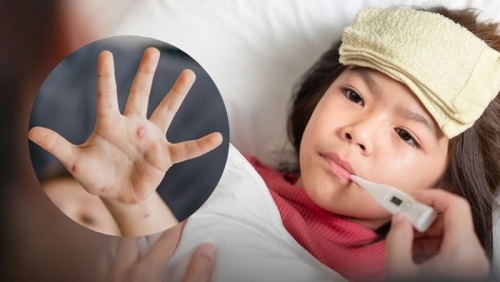 Bệnh thủy đậu là gì và cách điều trị ra sao? 