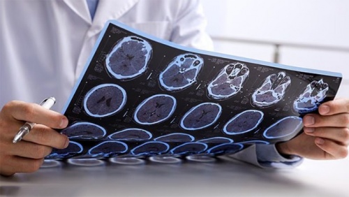 3 yếu tố làm tăng nguy cơ tử vong do bệnh đa xơ cứng