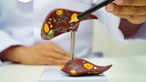 Tổng quan về sỏi đường mật trong gan: Những điều bạn cần biết