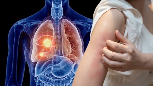 Dấu hiệu ngoài da cảnh báo u phổi