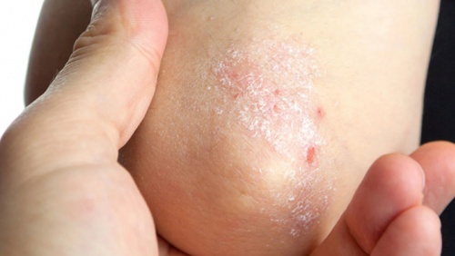 Cây sói rừng - thảo dược hỗ trợ cải thiện bệnh vảy nến hiệu quả