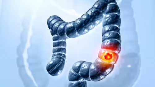 5 dấu hiệu ung thư đại tràng phổ biến dễ bị bỏ qua