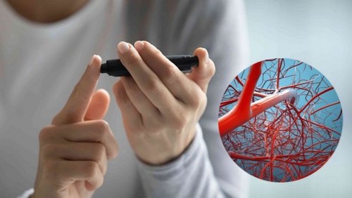 Mắc đái tháo đường: Cần biết gì về biến chứng mạch máu nhỏ của bệnh?