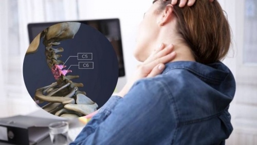 Thoát vị đĩa đệm C5-C6 phải làm sao?