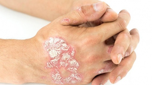 Bị vảy nến thể mảng cần lưu ý những gì?