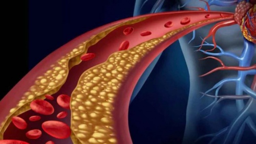 Rối loạn lipid máu có chữa khỏi được không?