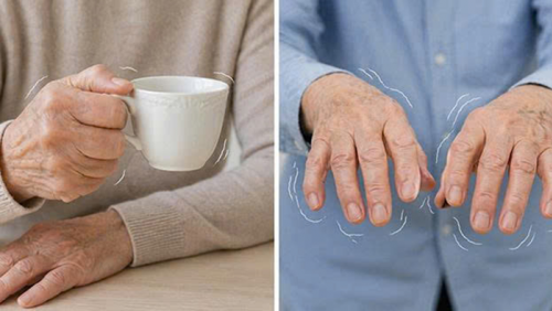 Cách phân biệt run do tuổi tác và run bệnh lý