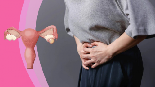 Giải pháp giúp kiểm soát u nang buồng trứng an toàn 