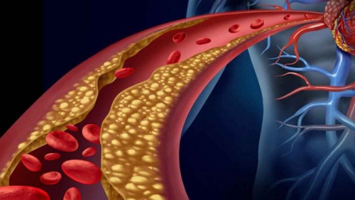 Rối loạn lipid máu: Nhận diện nguy cơ và giải pháp kiểm soát an toàn
