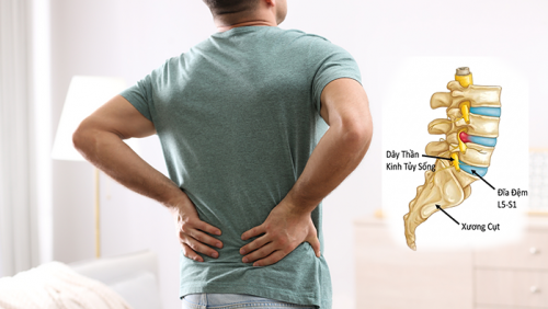 Triệu chứng cảnh báo thoát vị đĩa đệm lưng không nên bỏ qua