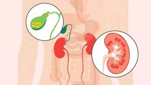 Sỏi mật có gây ra các vấn đề về đường tiết niệu không?