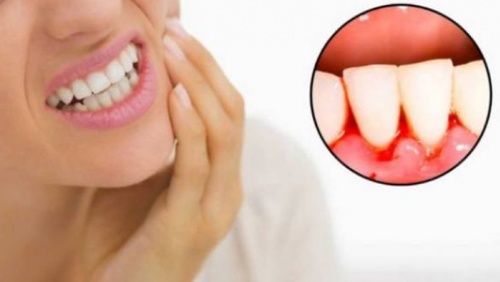 Chảy máu chân răng cảnh báo bệnh gì?