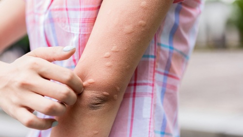 Nổi mề đay mùa Hè, phải làm sao?