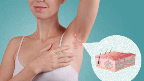Sống chung với viêm tuyến mồ hôi mủ trong mùa Hè