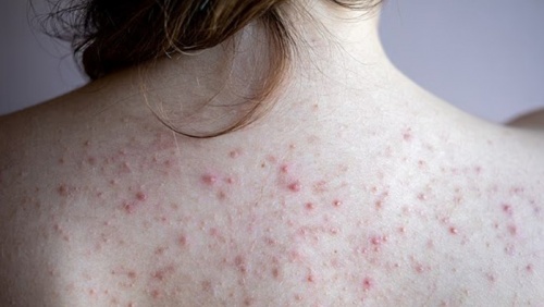 Bị mụn lưng phải làm sao?