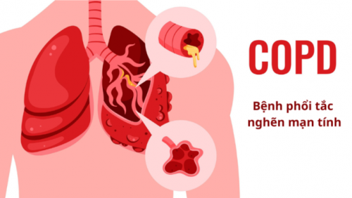 Cách nhận biết sớm bệnh phổi tắc nghẽn mạn tính (COPD)