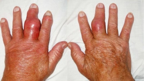 Hạt tophi xuất hiện ở người bệnh gout: Cảnh báo không nên chủ quan