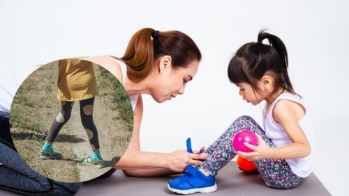 Khớp gối vẹo ngoài: Dáng đi bất thường ở trẻ cha mẹ nên theo dõi