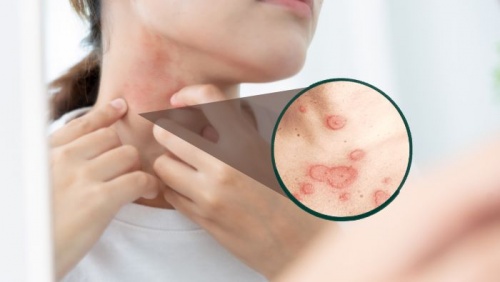 Lupus ban đỏ dạng đĩa có nguy hiểm không? 