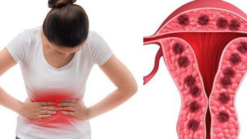 Một số bệnh phụ khoa có thể làm tăng nguy cơ bệnh tim và đột quỵ?
