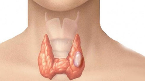 Bướu cổ đơn thuần có nguy hiểm không?
