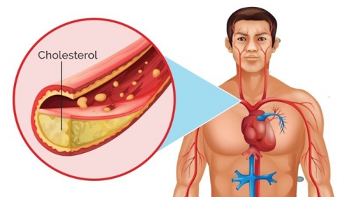 Bảo vệ trái tim trước mối nguy do tăng cholesterol