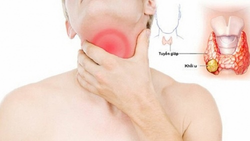 Có những loại bướu tuyến giáp nào?