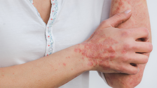 Những hiểu lầm khiến người bệnh vảy nến thêm tự ti