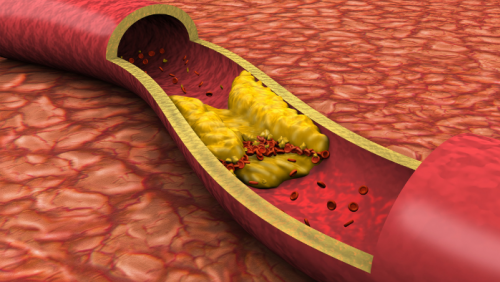 Cholesterol cao và xơ vữa động mạch: Mối liên hệ nhiều người còn chủ quan