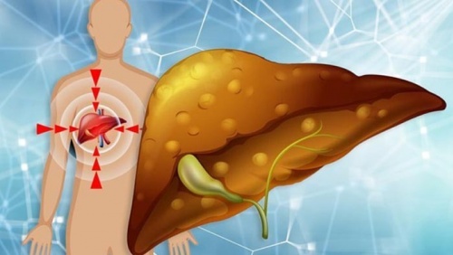 Có thể đảo ngược gan nhiễm mỡ mà không dùng thuốc?