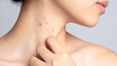 Hướng đi mới giúp kiểm soát bệnh lupus ban đỏ từ thảo dược tự nhiên