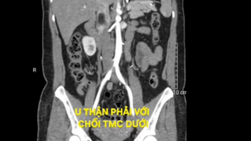 Tình cờ phát hiện u thận kèm huyết khối tĩnh mạch chủ