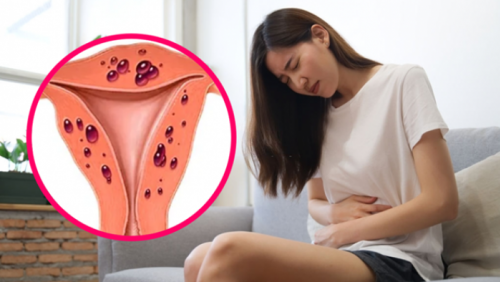 Vì sao lạc nội mạc tử cung thuờng được phát hiện muộn?