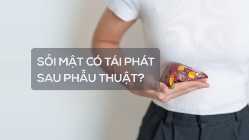 Sỏi mật có tái phát sau phẫu thuật không?