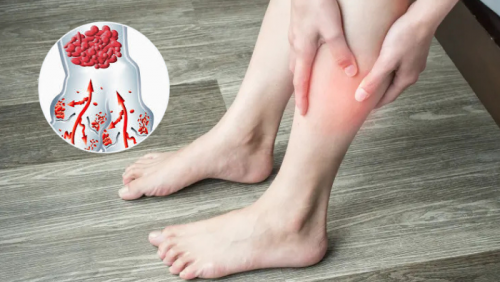 4 dấu hiệu cảnh báo cục máu đông phụ nữ không nên chủ quan