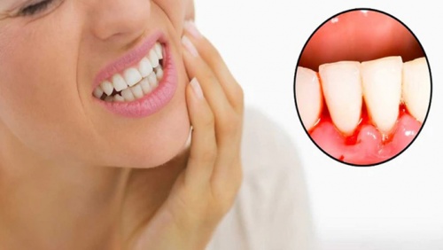 Bị viêm quanh răng có nguy hiểm không?