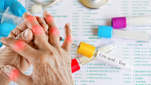 Chế độ ăn cho người có chỉ số acid uric tăng cao