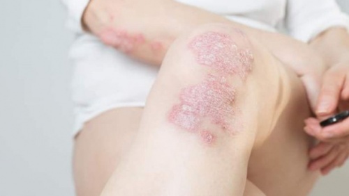 Chủ động kiểm soát vảy nến từ sớm để không lo bệnh bùng phát khi trời lạnh