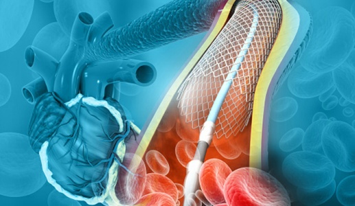 Bị tăng huyết áp, đái tháo đường đặt stent có khỏi hẳn bệnh mạch vành không?