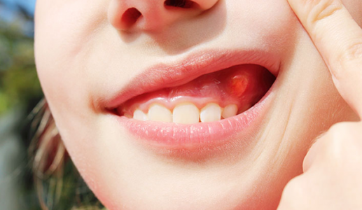 Viêm chân răng có mủ: Biến chứng nghiêm trọng với răng miệng