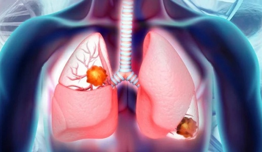 Ung thư phổi giai đoạn cuối: Những điều cần biết
