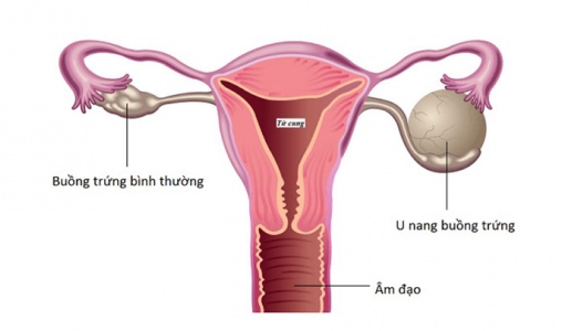 U nang buồng trứng có nguy hiểm không và cách cải thiện hiệu quả