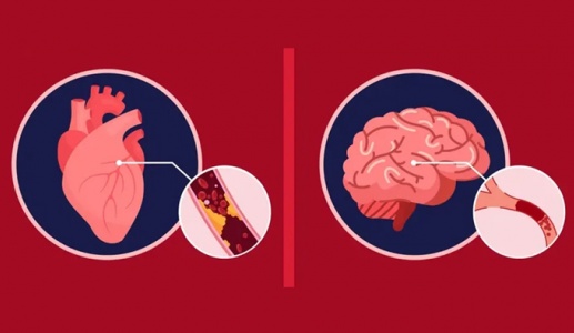 Tại sao rung nhĩ là bệnh tim nhưng có thể gây biến chứng lên não?