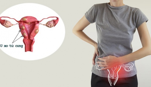 Dấu hiệu u xơ tử cung và cách cải thiện hiệu quả từ thảo dược